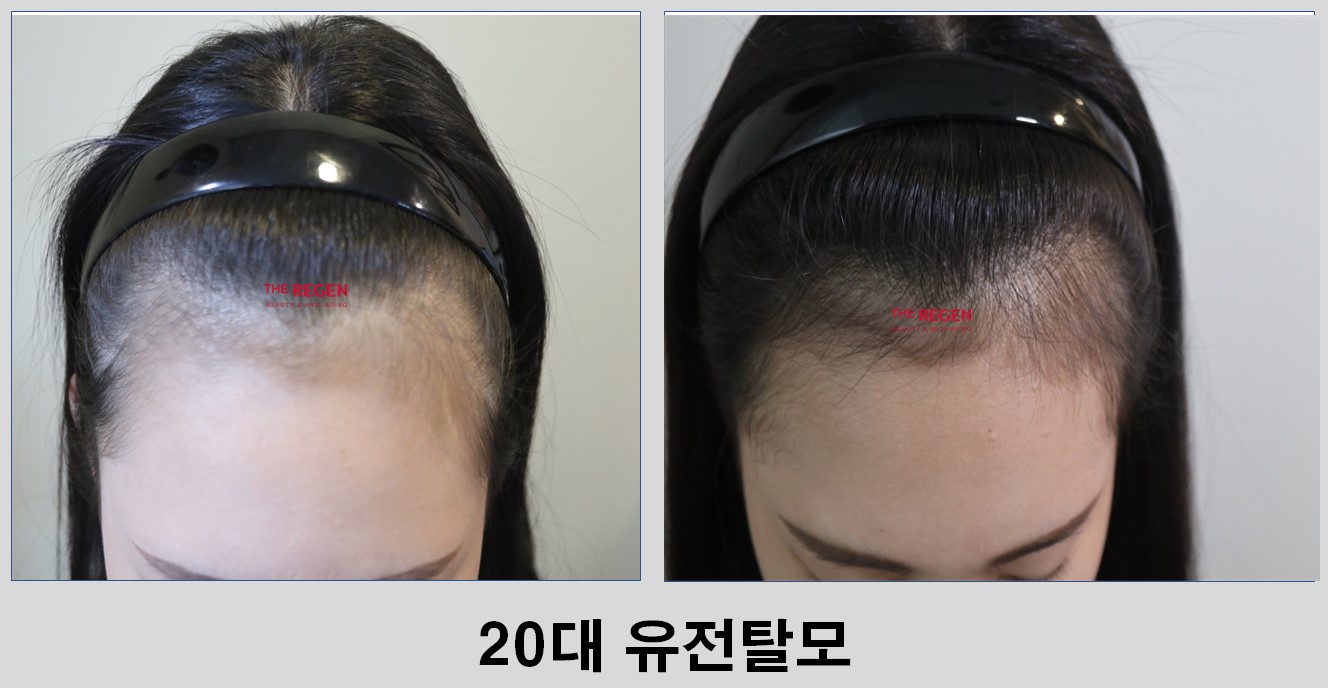 20대 여성 유전탈모 before after